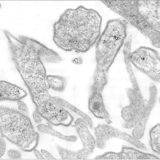 mumps, pcr qualitative